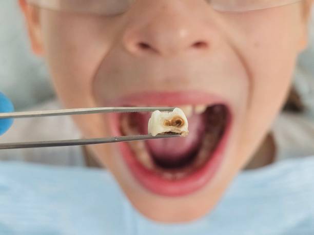 Best Emergency Root Canal Therapy in Savanna, IL